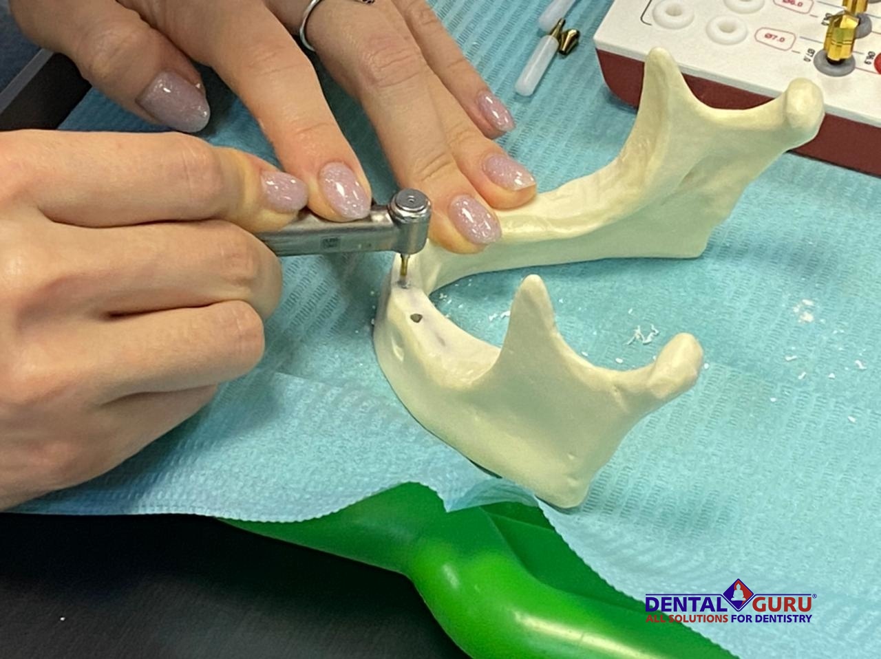 «Стоматологическая реабилитация с помощью ангулированных имплантатов. Имплантация на 4-х имплантатах. Физиологическое и анатомическое обоснование». Пост-релиз 31.01.21