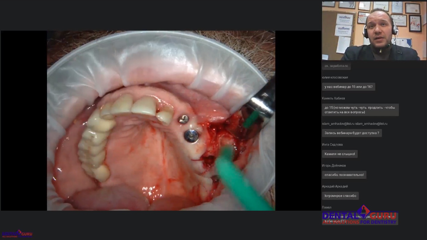 Пост-релиз: Взаимодействие имплантолога и лор-врача при проведении имплантации и костной пластики в компрометированной пазухе