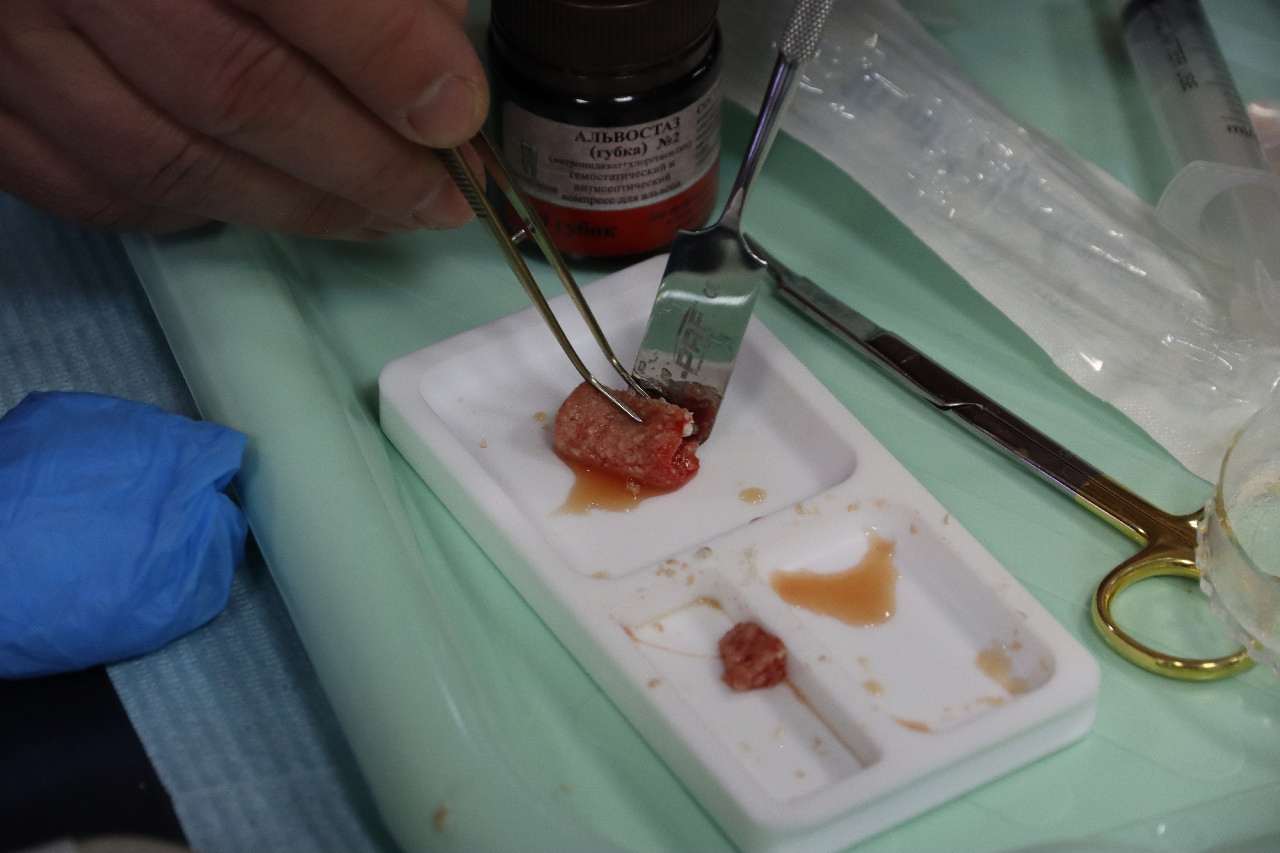 Плазмотерапия PRF в стоматологии