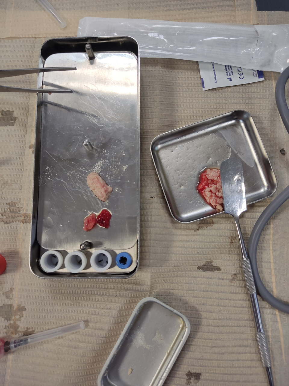 Плазмотерапия PRF в стоматологии