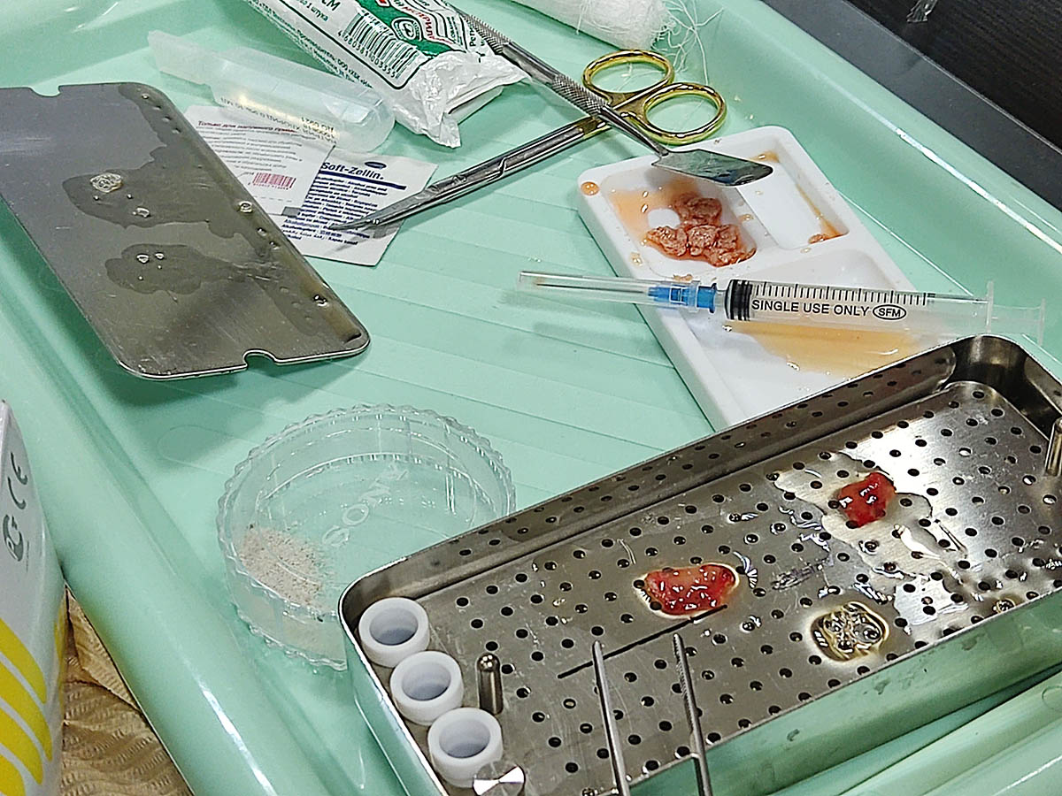 Плазмотерапия PRF в стоматологии. Пост-релиз 2 сентября