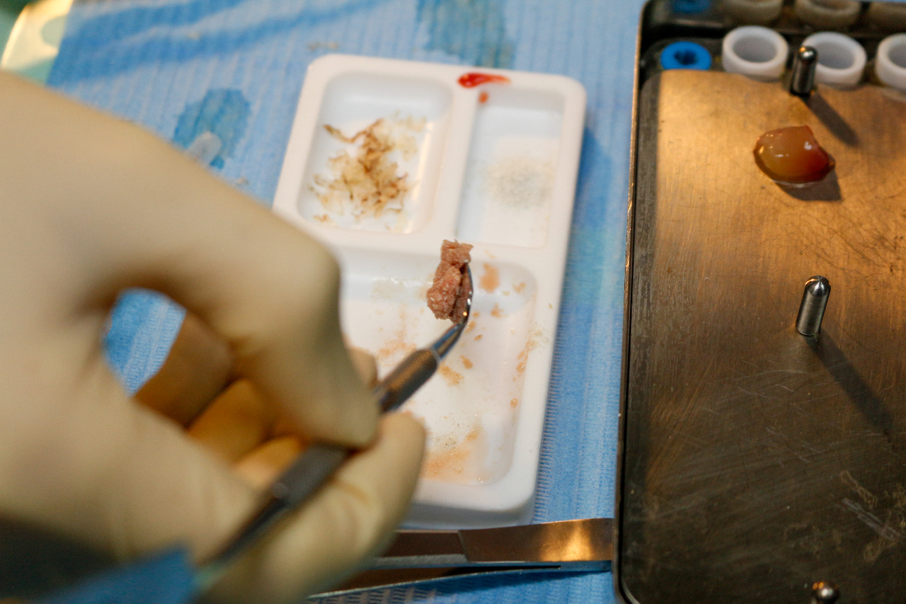 Плазмотерапия PRF в стоматологии 29.09.23