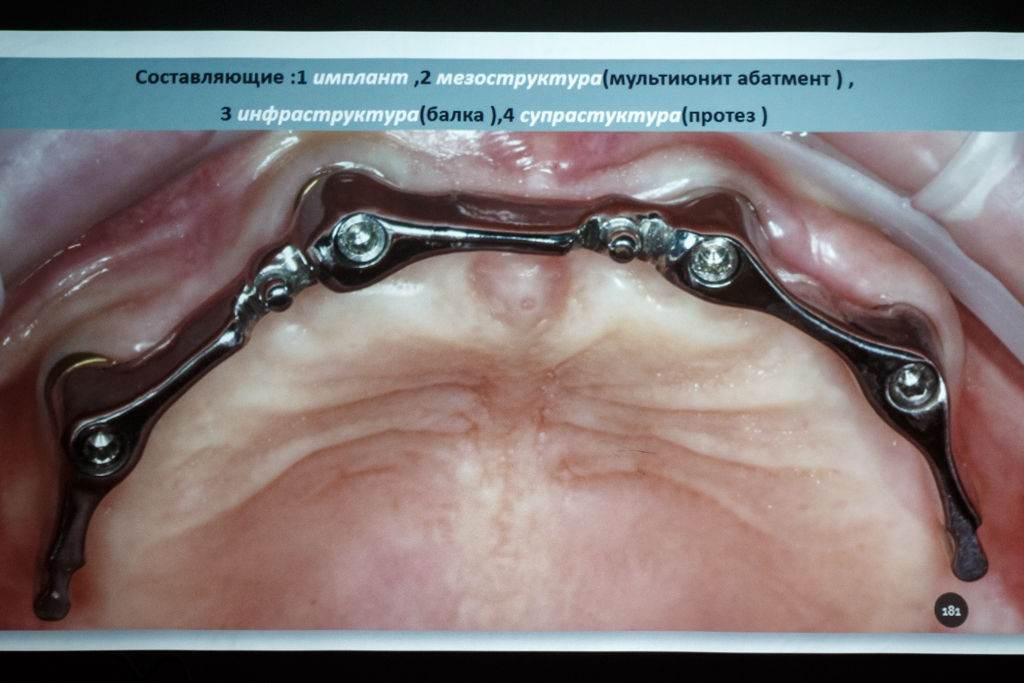 Стоматологическая реабилитация с помощью ангулированных имплантов. Физиологическое и анатомическое обоснование