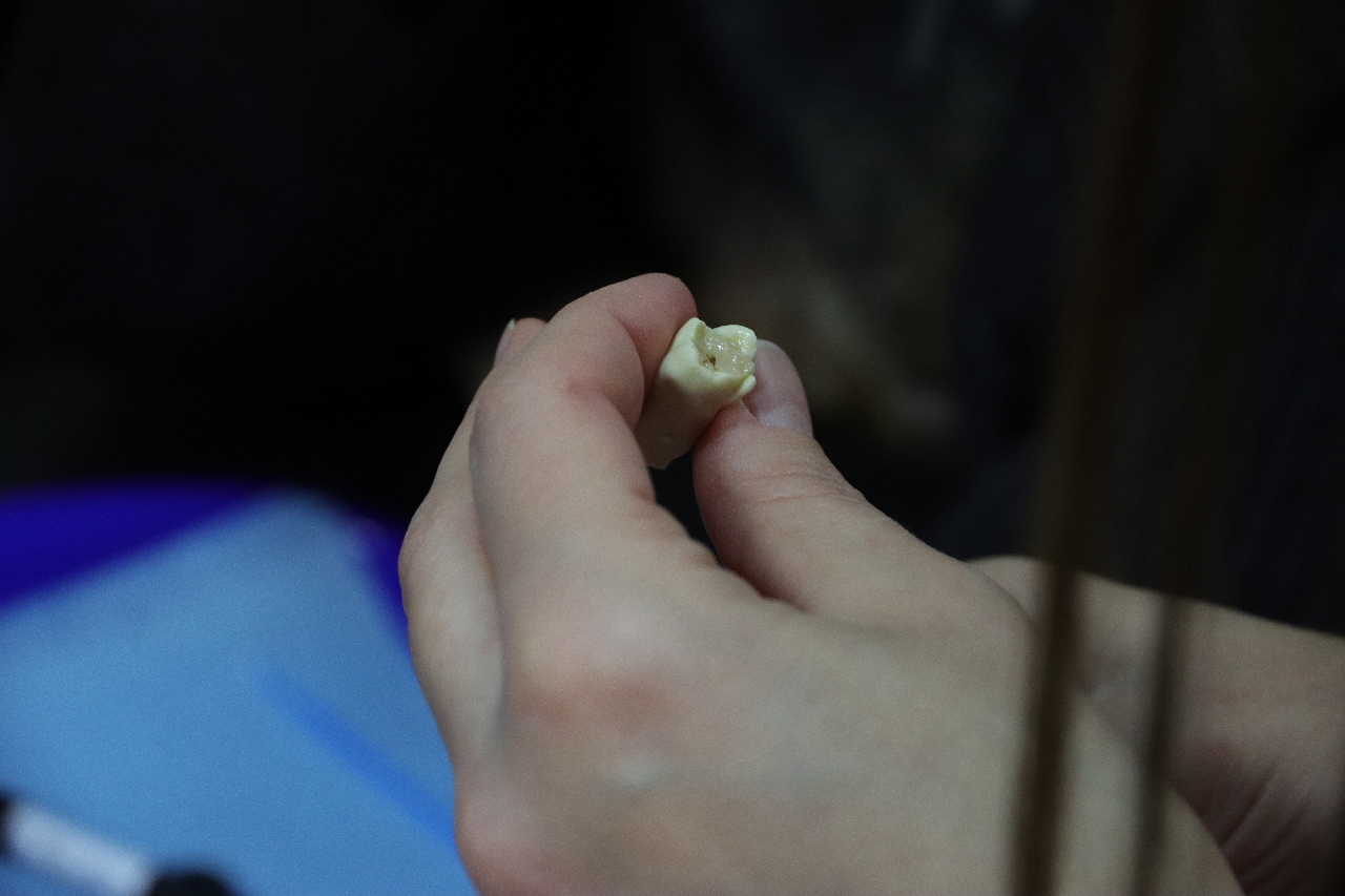 Прямые методы реставраций жевательной группы зубов