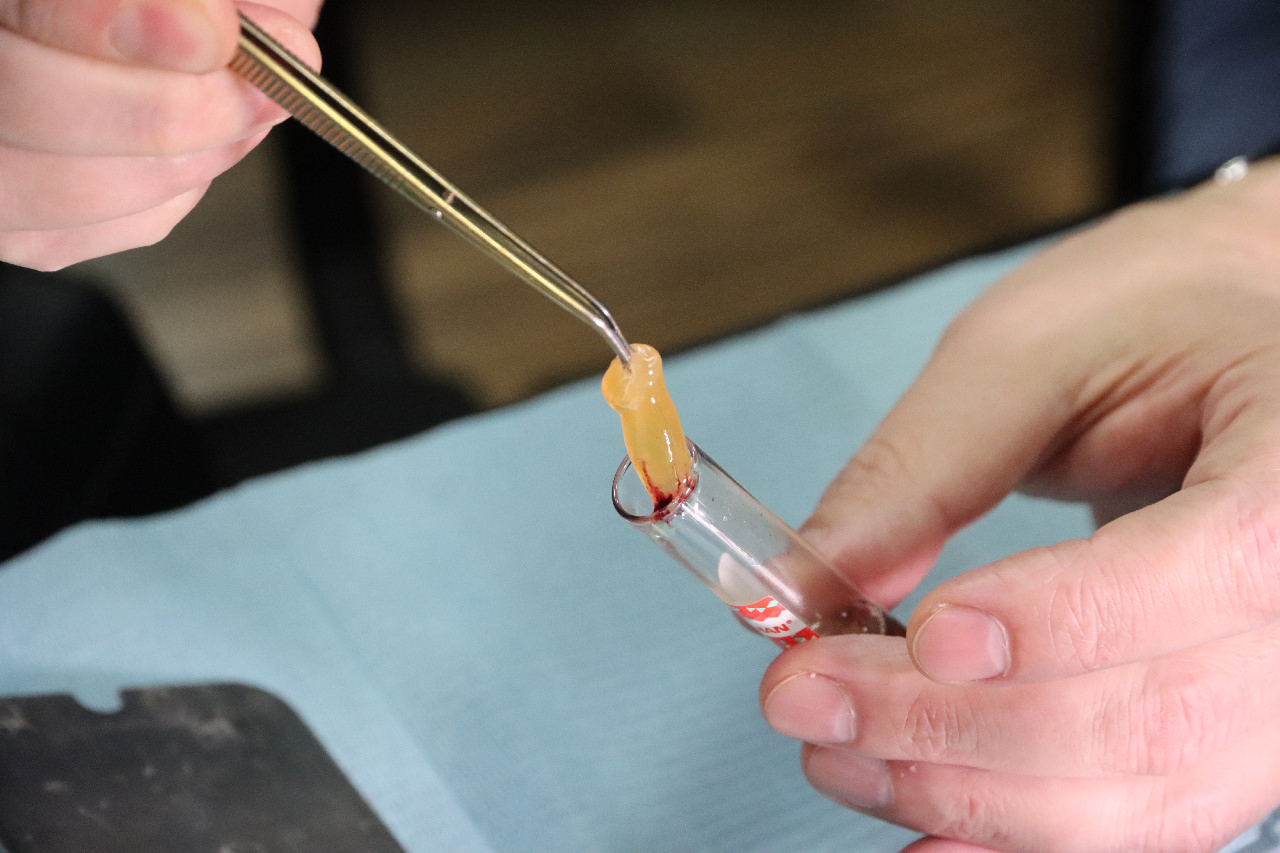 Плазмотерапия PRF в стоматологии