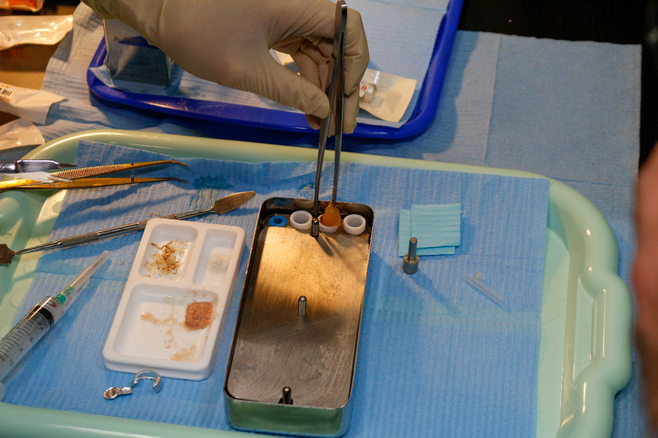 Плазмотерапия PRF в стоматологии 29.09.23