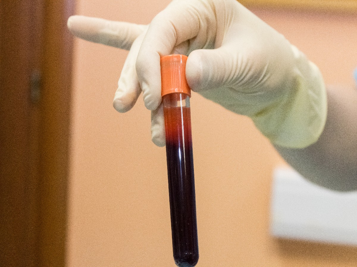 Применение плазмы с высоким содержанием фибрина (IPRF) в эстетической медицине