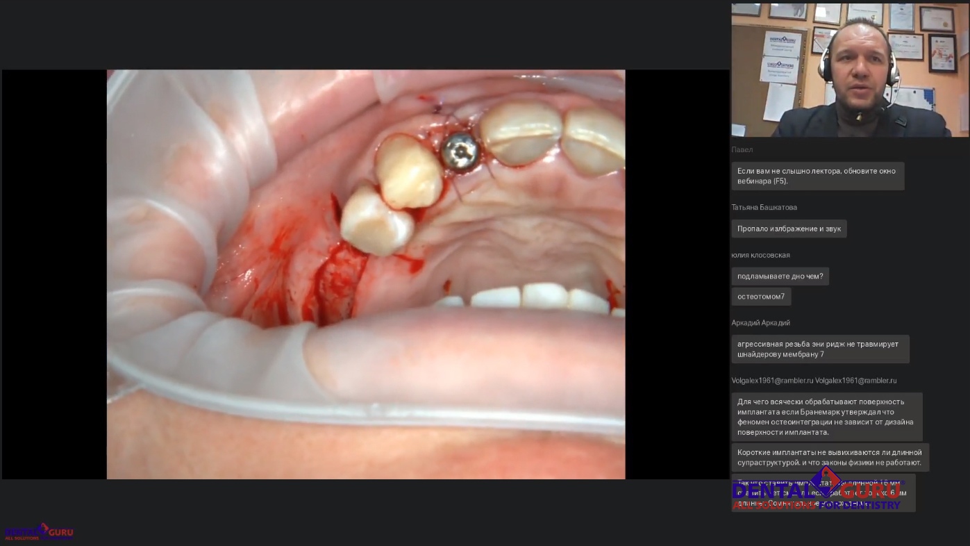 Пост-релиз: Взаимодействие имплантолога и лор-врача при проведении имплантации и костной пластики в компрометированной пазухе