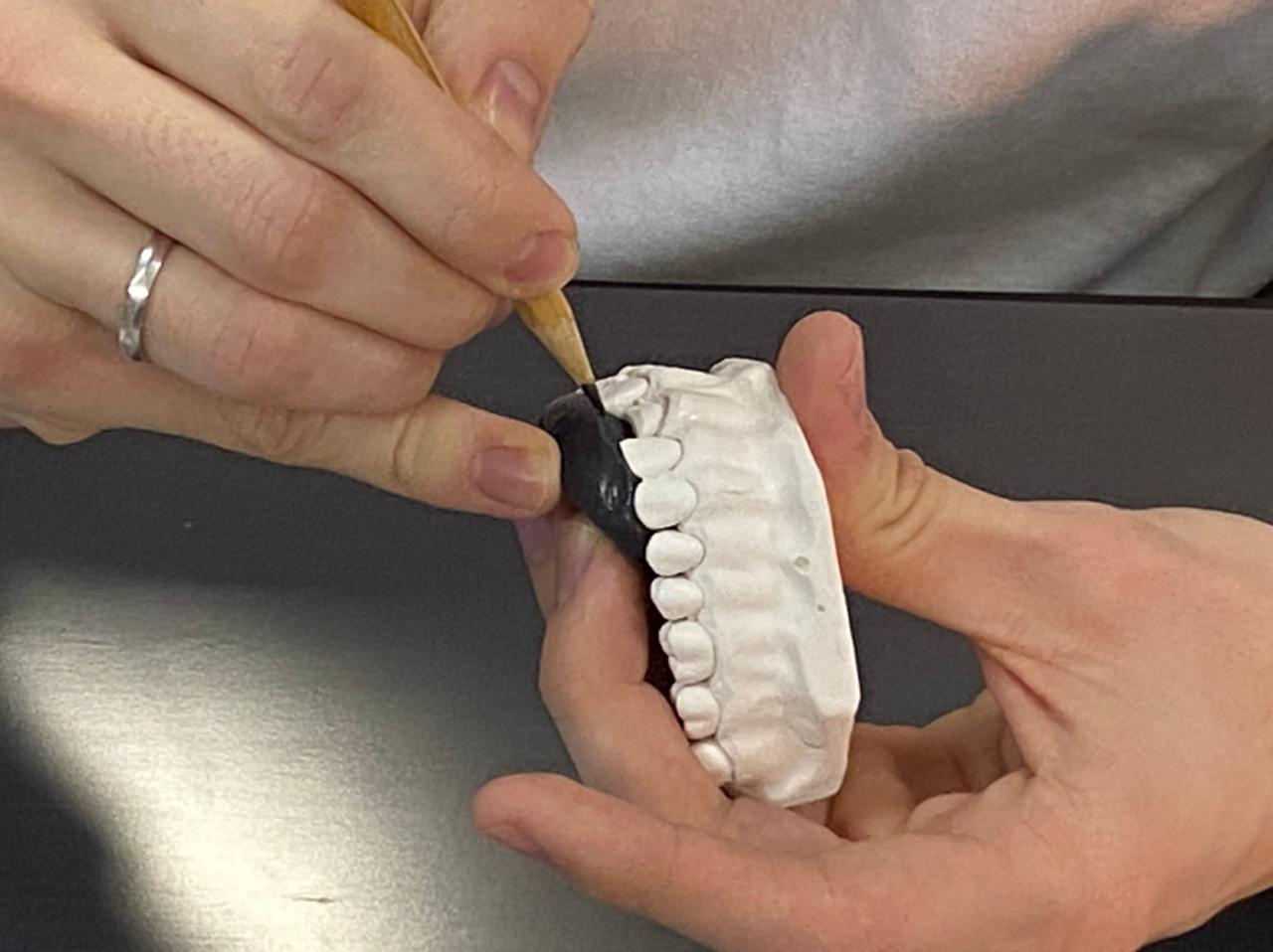 Прямые композитные виниры. Полный алгоритм и немного больше. Пост-релиз 3 марта 2021