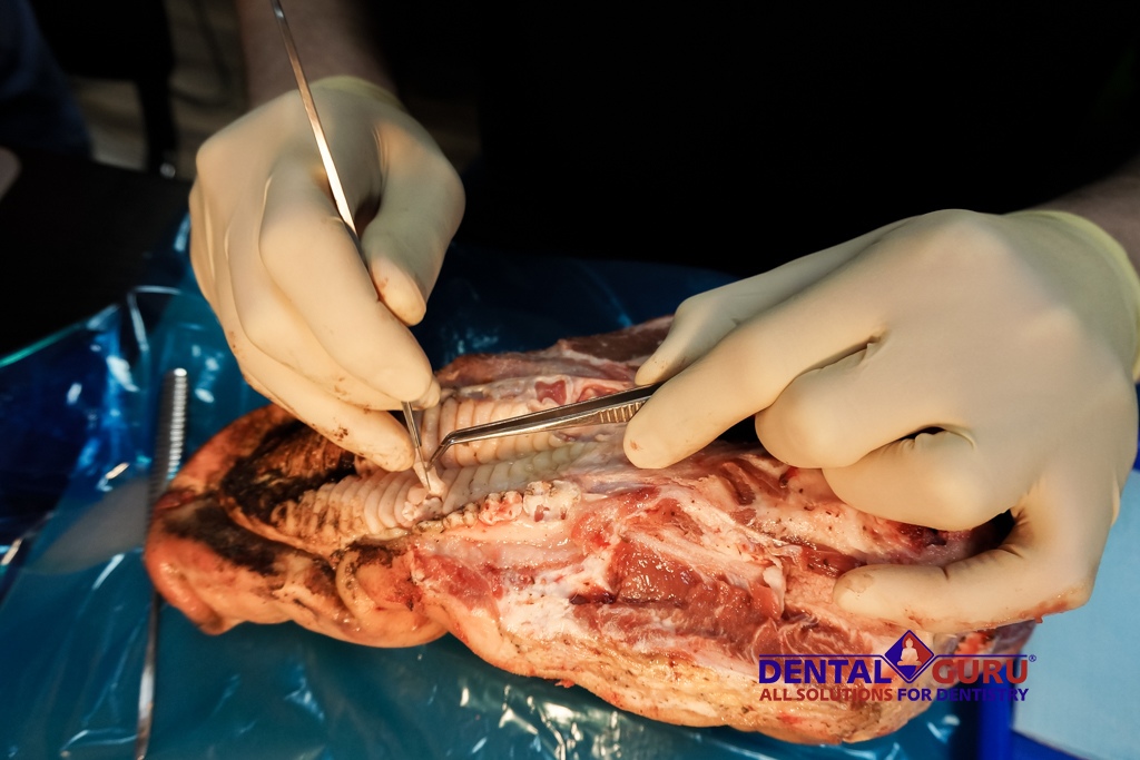 Пластика мягких тканей вокруг имплантатов. Морфологический подход