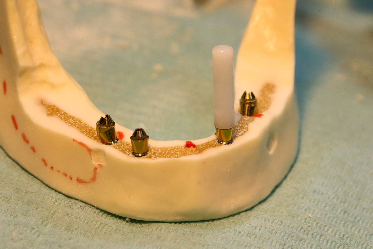 Стоматологическая реабилитация с помощью ангулированных имплантатов