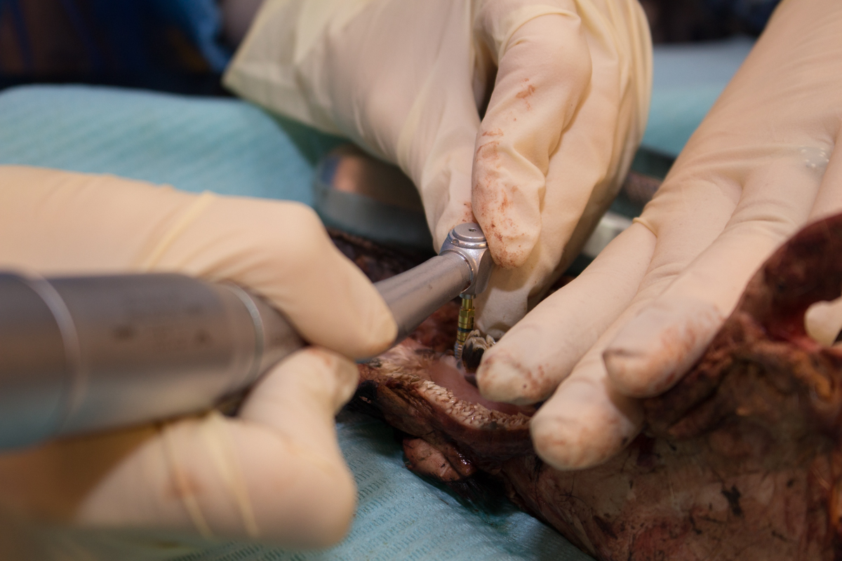 Одномоментная имплантация и немедленная нагрузка. 3 февраля 2020