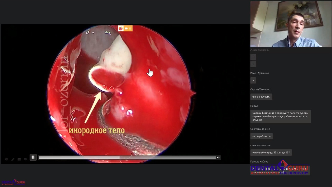 Пост-релиз: Взаимодействие имплантолога и лор-врача при проведении имплантации и костной пластики в компрометированной пазухе