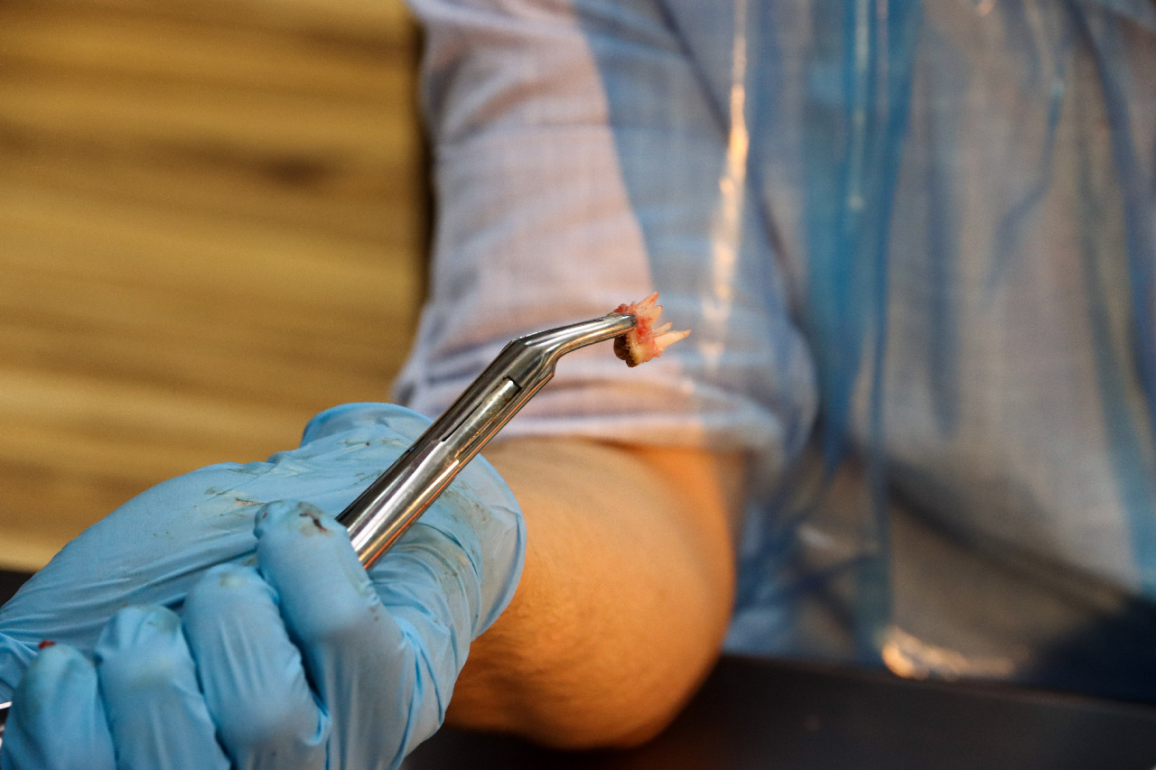 Атравматичное удаление зубов и методики наложения швов