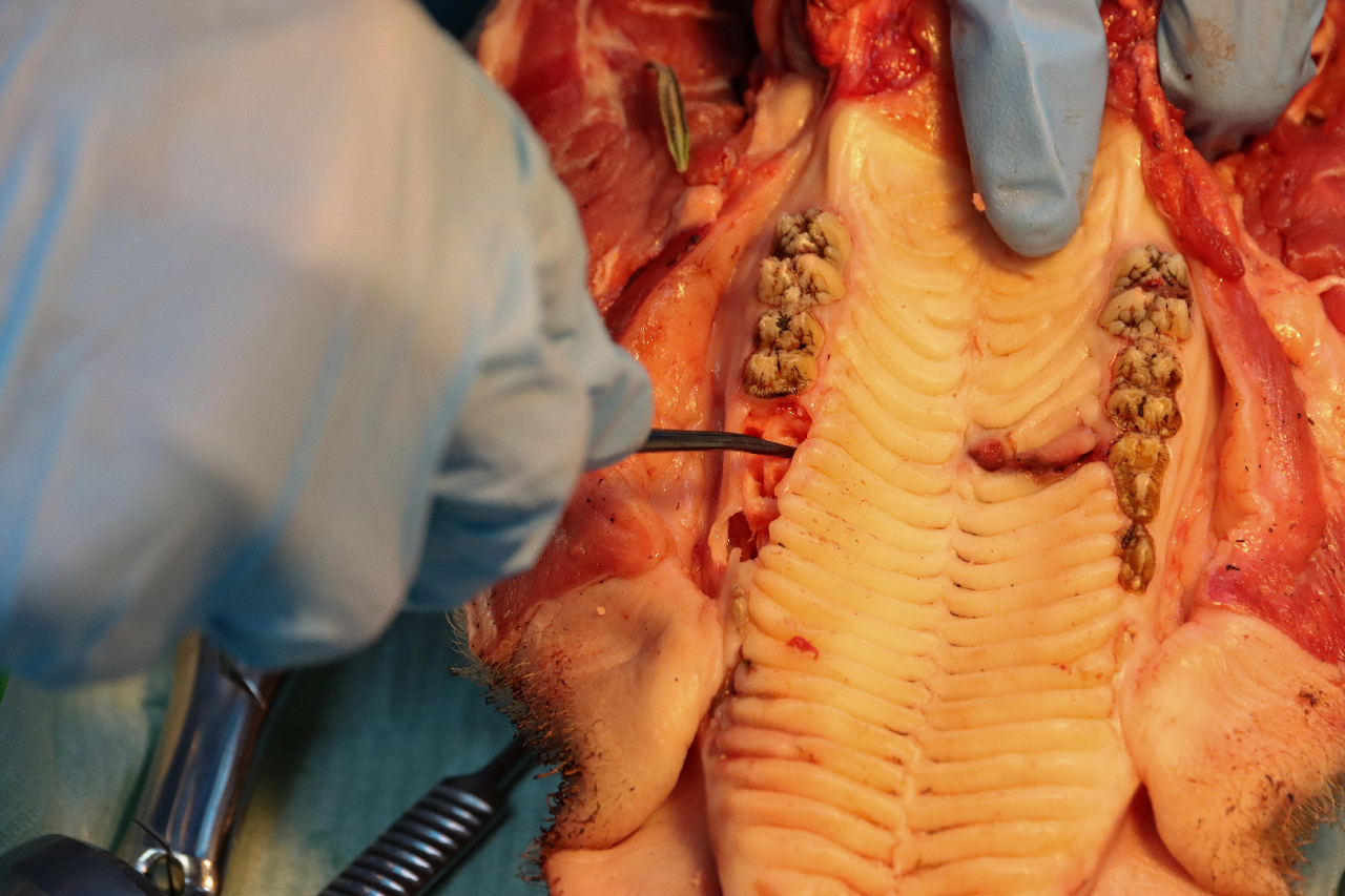 Атравматичное удаление зубов и методики наложения швов