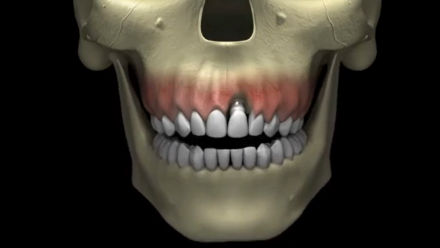 Предохраняющий абатмент. Fuse abutment