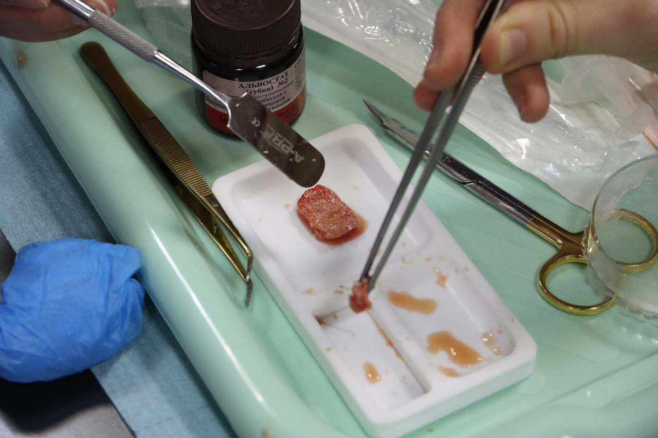 Плазмотерапия PRF в стоматологии