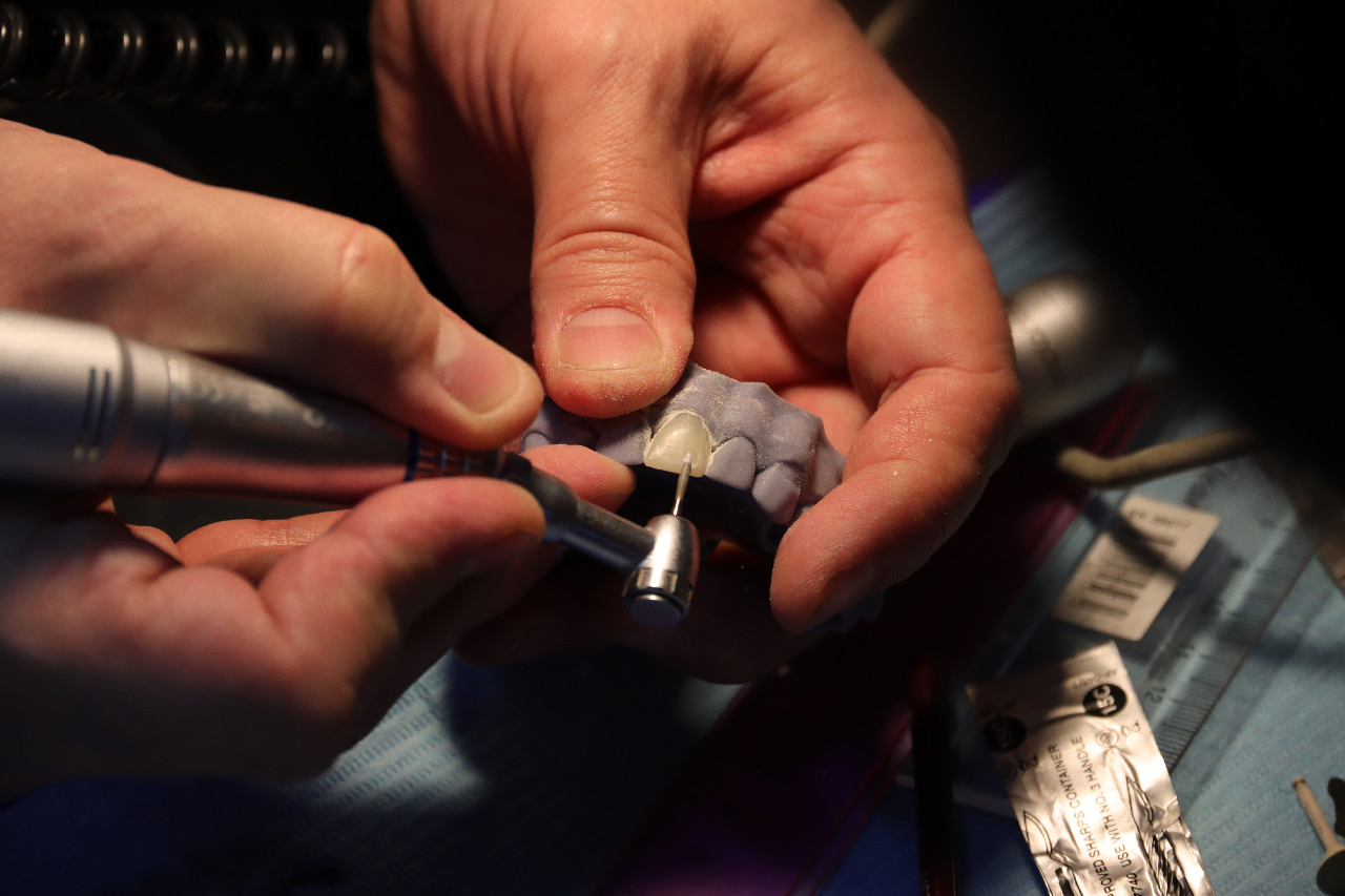 Прямые композитные виниры. Полный алгоритм и немного больше