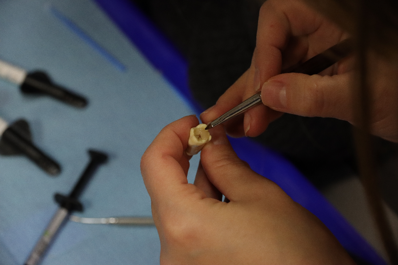 Прямые методы реставраций жевательной группы зубов