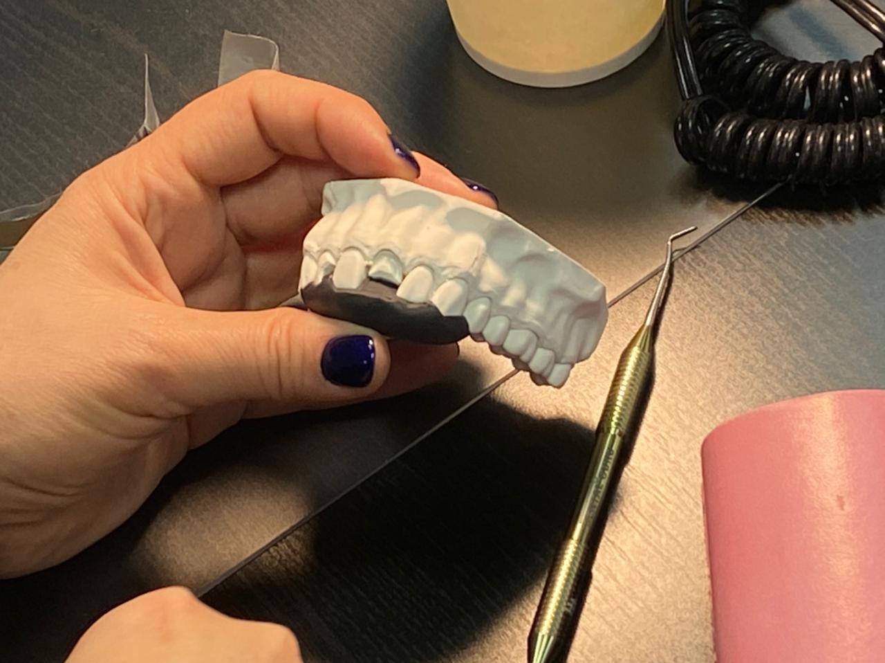 Прямые композитные виниры. Полный алгоритм и немного больше. Пост-релиз 3 марта 2021