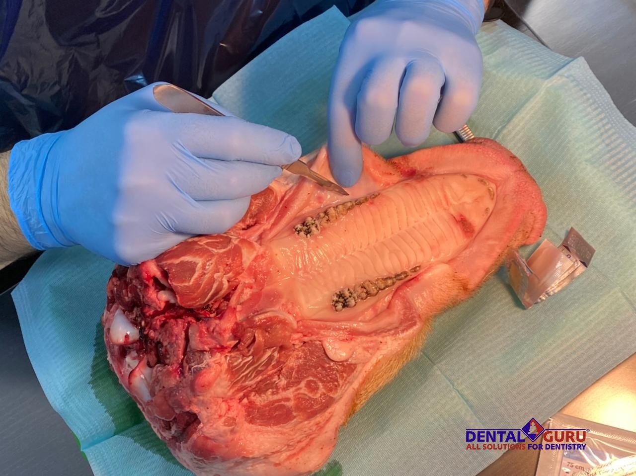 Пластика мягких тканей вокруг имплантатов. Морфологический подход. Пост-релиз 11-12 февраля