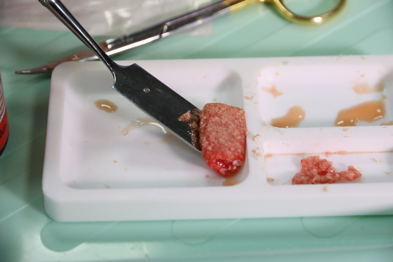 Плазмотерапия PRF в стоматологии