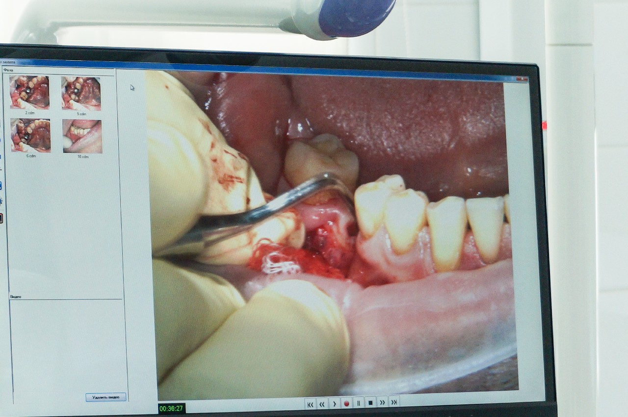Модульный курс - Обучение секретам и нюансам имплантации на практике в условиях клиники