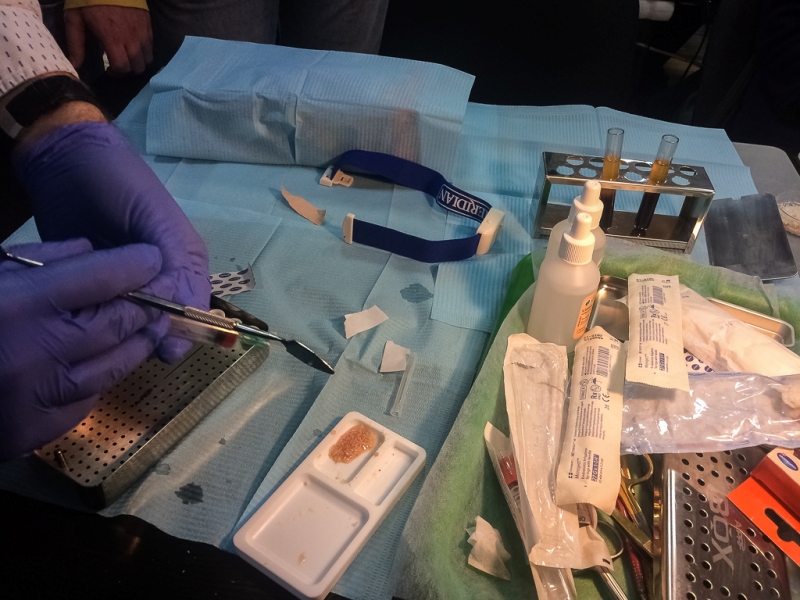 Атравматичное удаление зубов и методики наложения швов