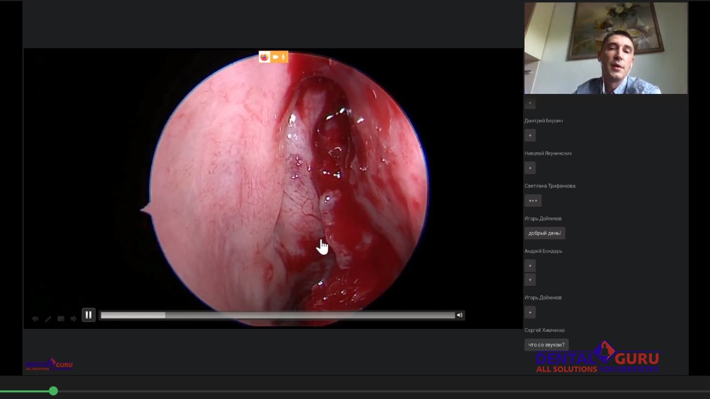 Пост-релиз: Взаимодействие имплантолога и лор-врача при проведении имплантации и костной пластики в компрометированной пазухе