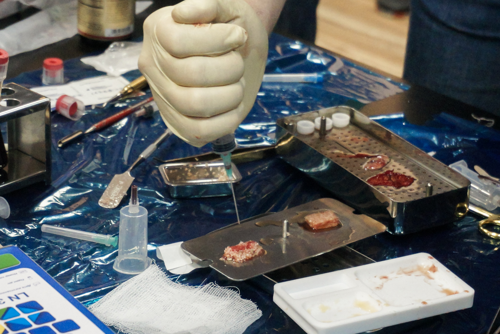 Применение факторов роста (IPRF, APRF) в хирургии и костной пластике