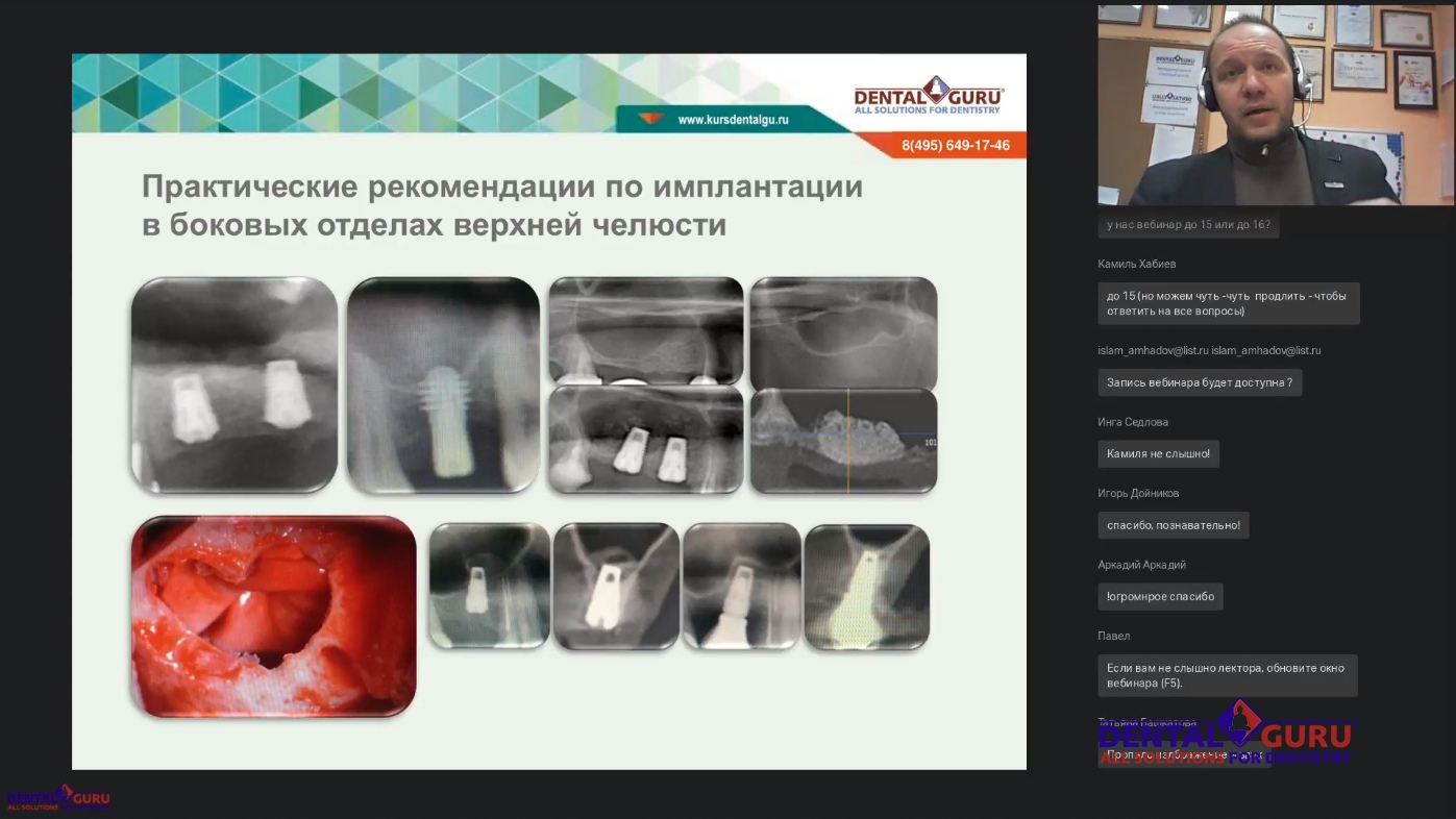 Пост-релиз: Взаимодействие имплантолога и лор-врача при проведении имплантации и костной пластики в компрометированной пазухе