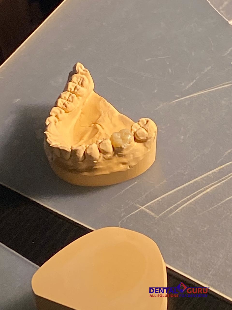 Прямые реставрации повышенной прочности. Пост-релиз 17.12.20