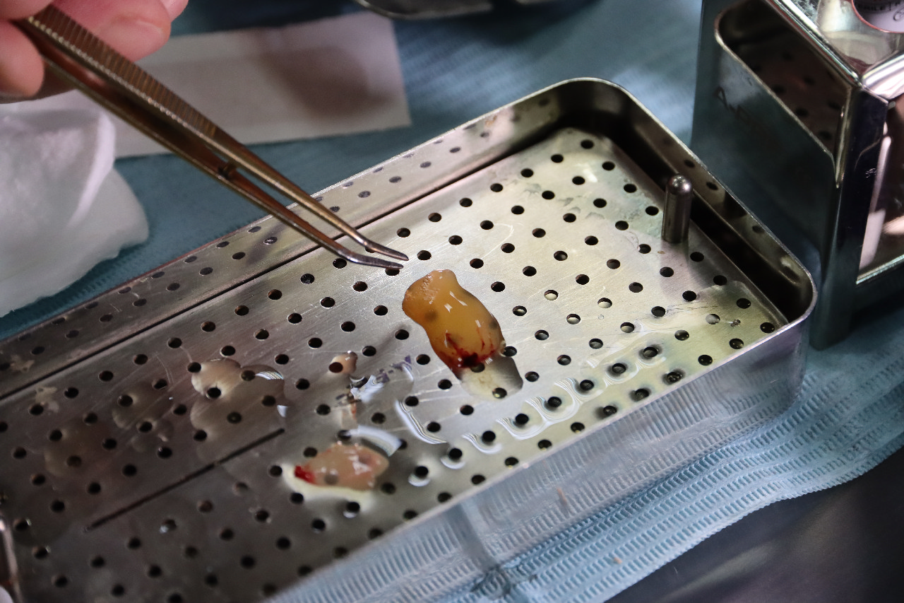 Плазмотерапия PRF в стоматологии