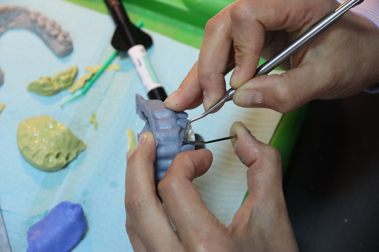 Прямые композитные виниры. Полный алгоритм и немного больше