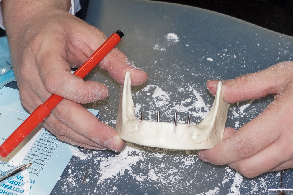 Стоматологическая реабилитация с помощью ангулированных имплантов. Физиологическое и анатомическое обоснование