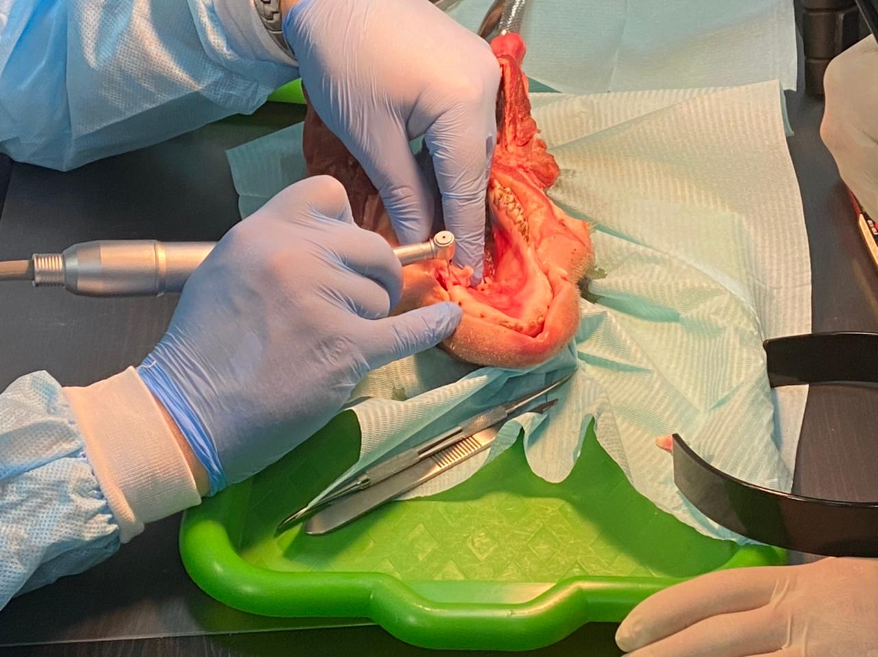 Дентальная имплантация с одновременной пластикой мягких тканей в сложных клинических случаях. 3 апреля 2021