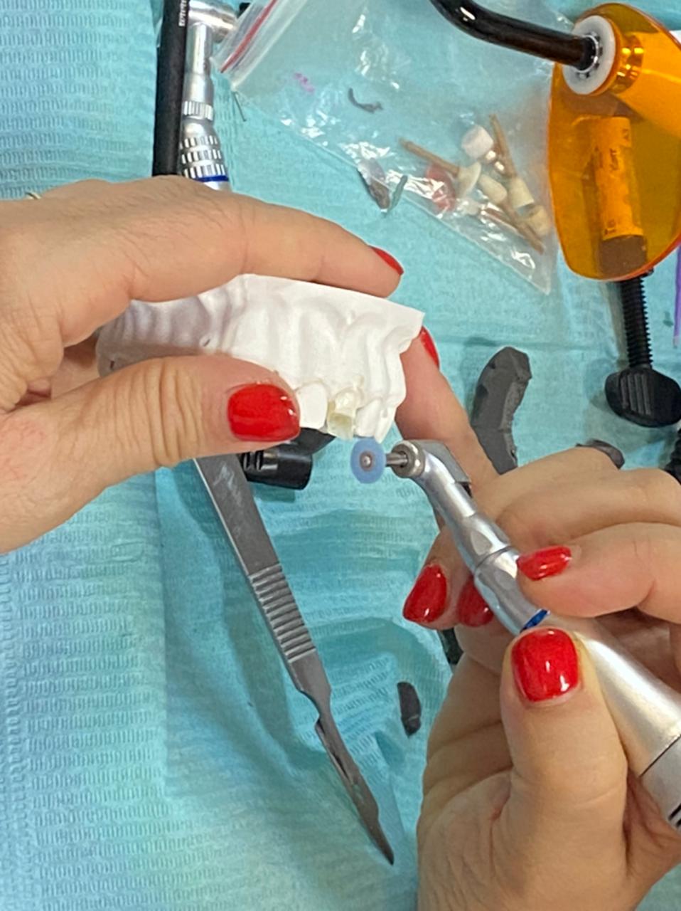 Прямые композитные виниры. Полный алгоритм и немного больше. Пост-релиз 3 марта 2021