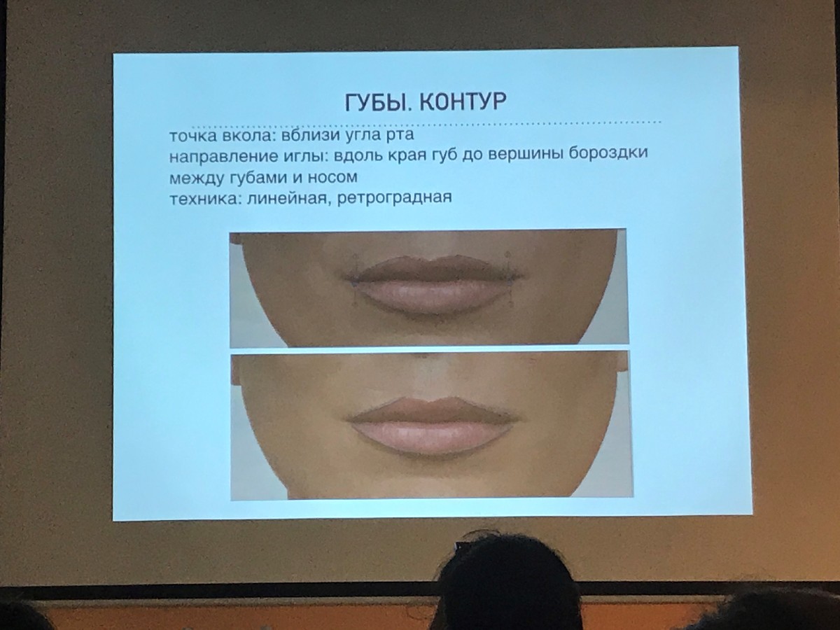 Применение плазмы с высоким содержанием фибрина (IPRF) в эстетической медицине.  17 ноября  2019. Сечко Нина Андреевна