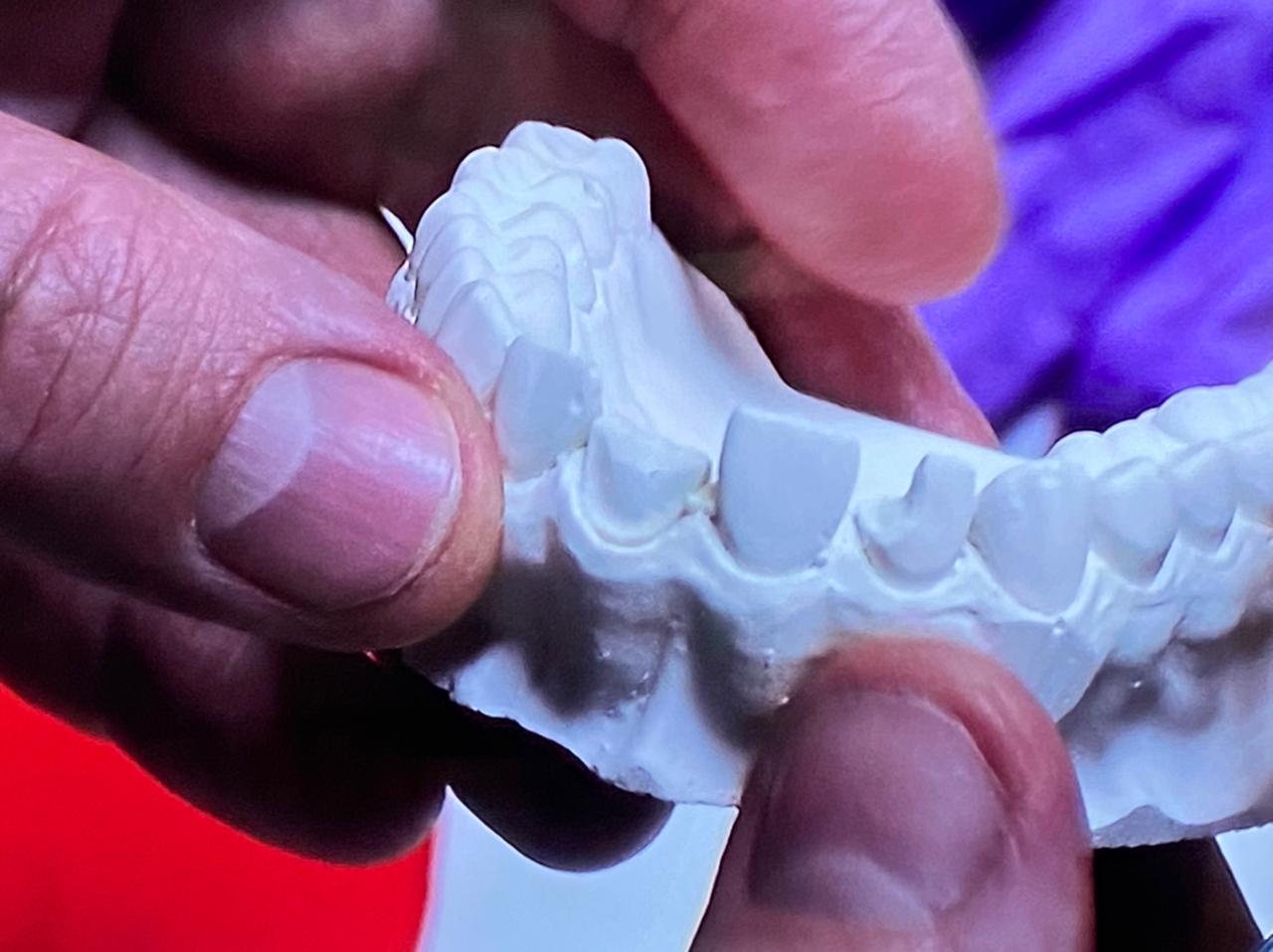 Прямые композитные виниры. Полный алгоритм и немного больше. Пост-релиз 3 марта 2021