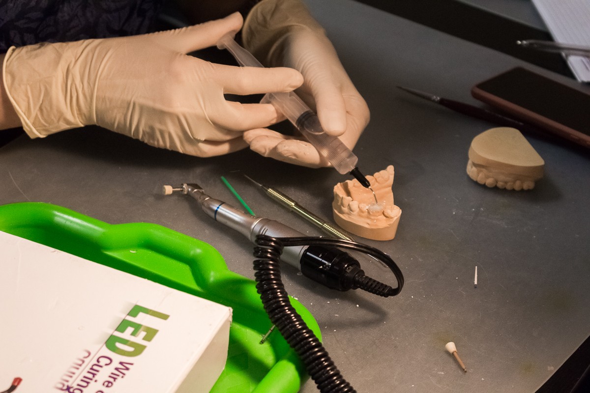 Прямые реставрации повышенной прочности. Эффективная альтернатива ортопедии стекловолоконные каркасные конструкции