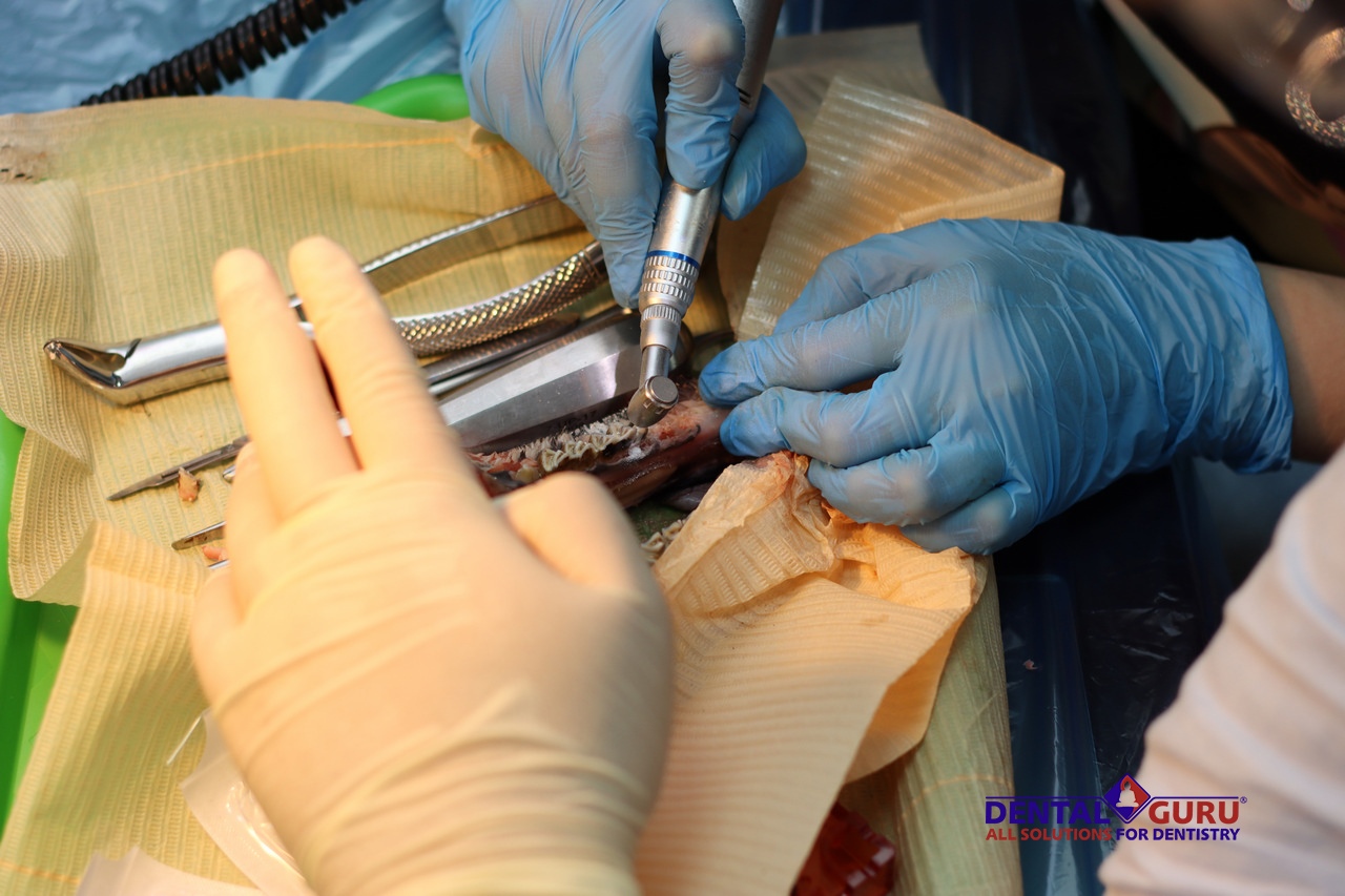 Атравматичное удаление зубов и методики наложения швов. Пост-релиз 3 августа 2021