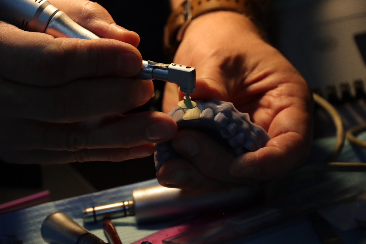 Прямые композитные виниры. Полный алгоритм и немного больше