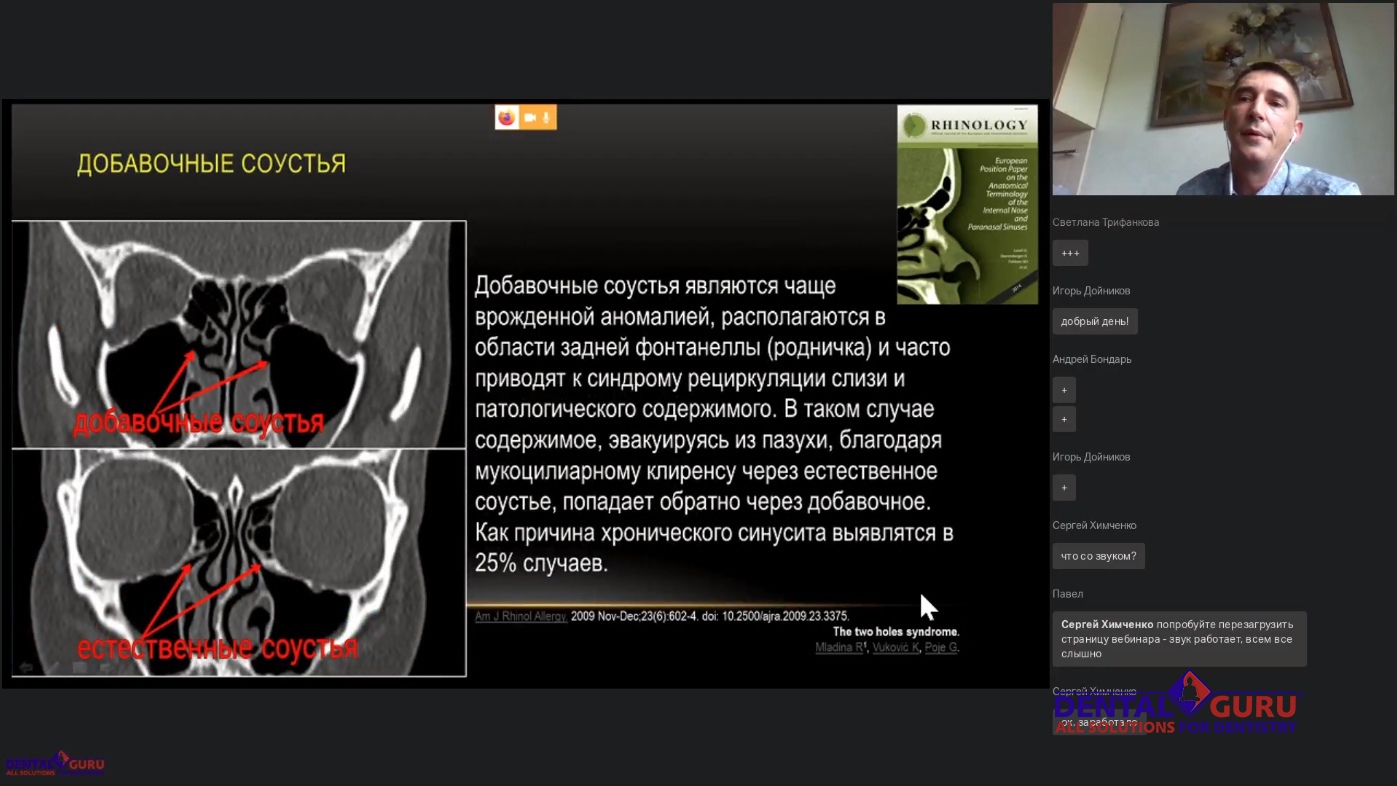 Пост-релиз: Взаимодействие имплантолога и лор-врача при проведении имплантации и костной пластики в компрометированной пазухе