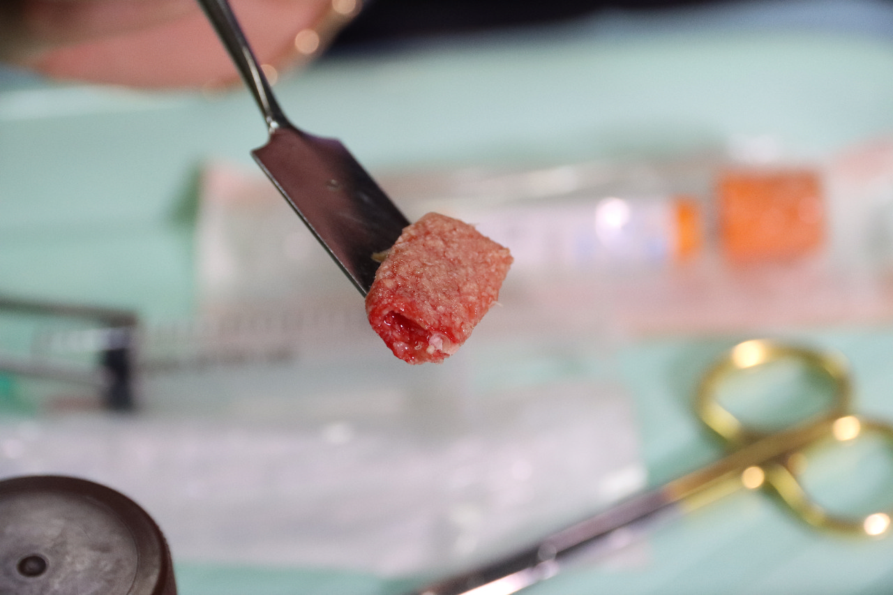 Плазмотерапия PRF в стоматологии