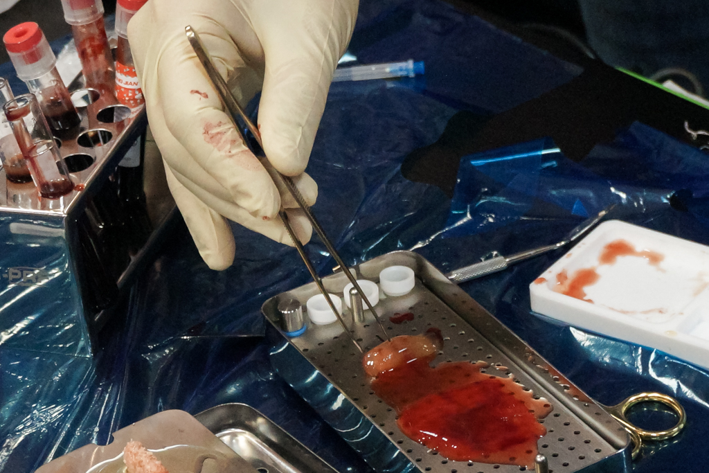 Применение факторов роста (IPRF, APRF) в хирургии и костной пластике