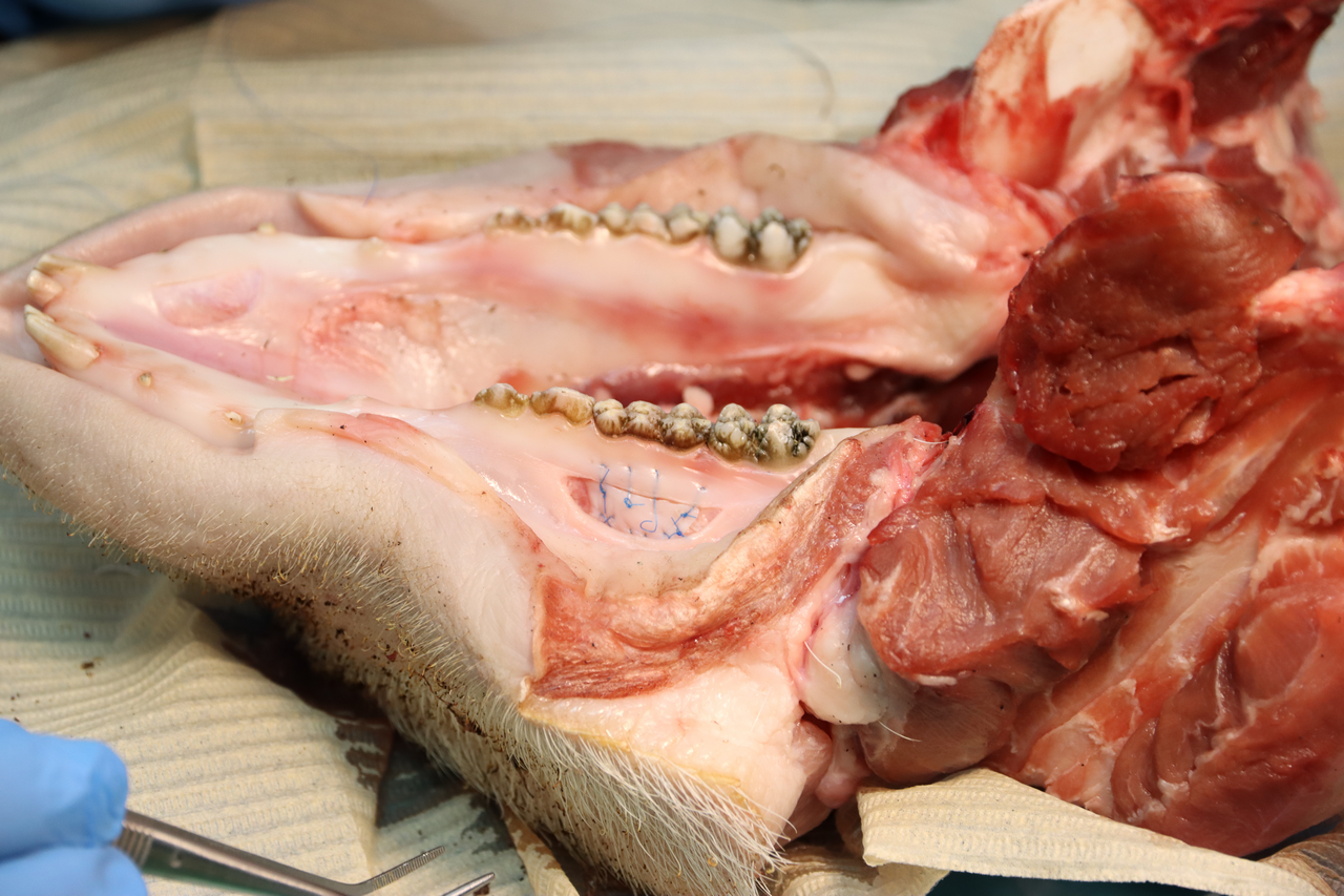 Дентальная имплантация с одновременной пластикой мягких тканей в сложных клинических случаях