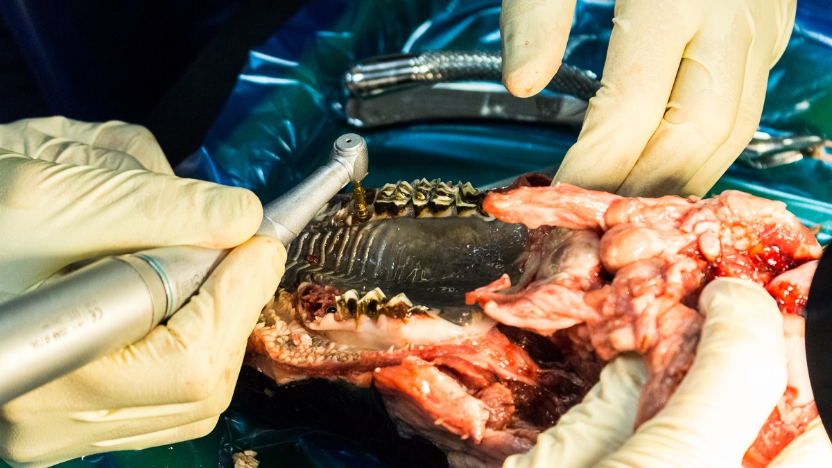 Одномоментная имплантация и немедленная нагрузка