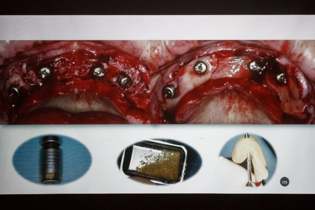 Стоматологическая реабилитация с помощью ангулированных имплантов. Физиологическое и анатомическое обоснование