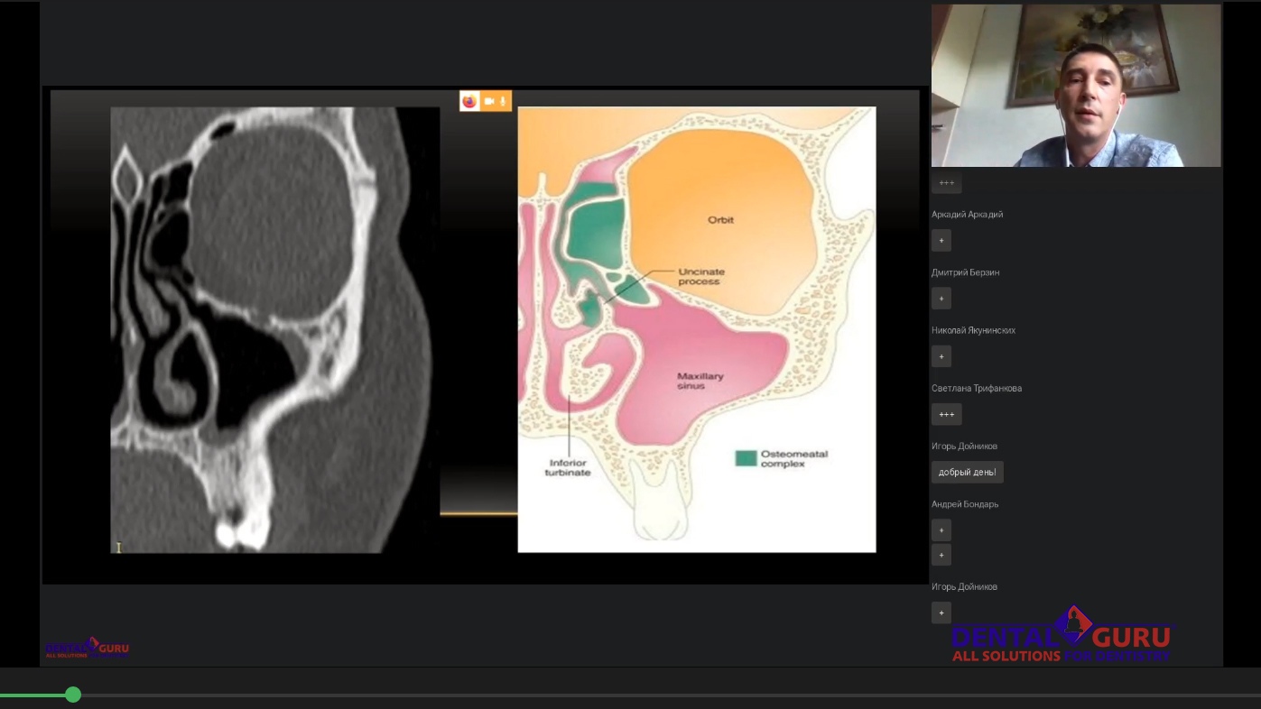 Пост-релиз: Взаимодействие имплантолога и лор-врача при проведении имплантации и костной пластики в компрометированной пазухе