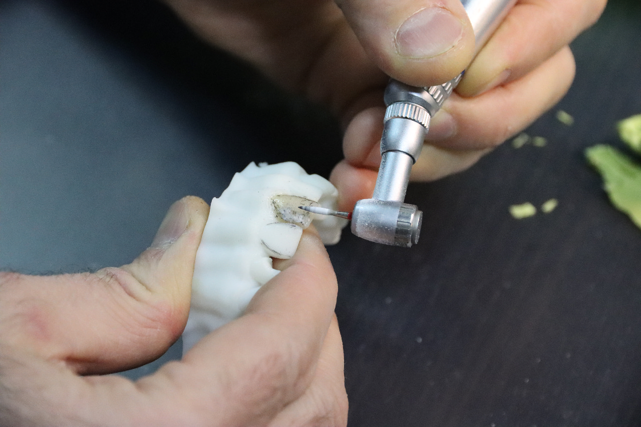 Прямые композитные виниры. Полный алгоритм и немного больше